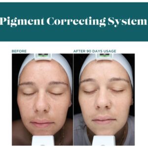 Before and after photos showing pigment correction results.